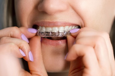 a patient wearing their Spark clear aligner