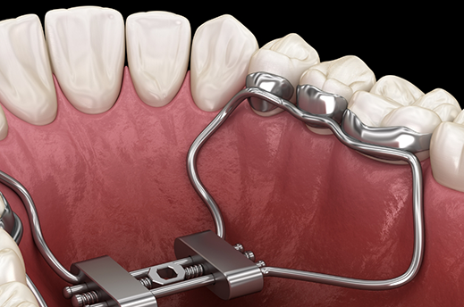 Illustration of a palatal expander on the roof of the mouth