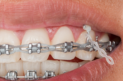 Close up of a smile with braces and a broken bracket