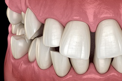 Illustration of gapped teeth