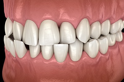 Illustration of a crossbite